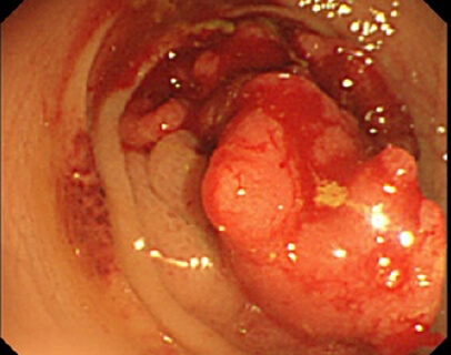 下部消化管内視鏡検査（大腸カメラ）