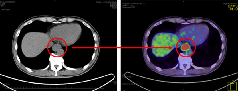 【左図】CT検査：食道がん 【右図】PET検査：高集積を示した食道がん