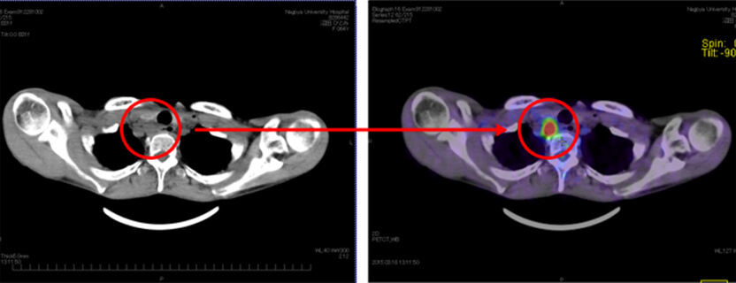 【左図】CT検査：膨張した頚部リンパ節 【右図】PET検査：高集積を示し転移と判明した頚部リンパ節