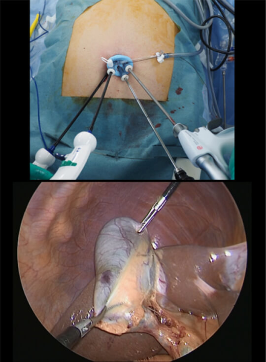 当科での単孔式腹腔鏡下胆嚢摘出術 図1