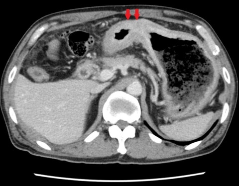 胃がん(胃壁の肥厚 赤矢印)