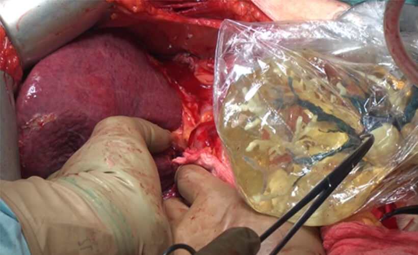 腹腔鏡手術：3次元モデルナビゲーション01